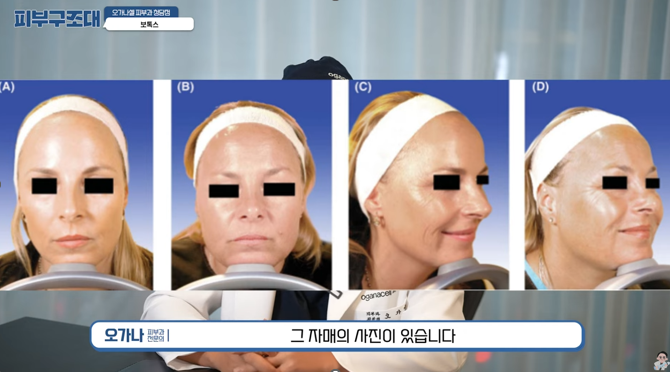 보톡스 내성 생기면 어쩌죠? 20년간 맞은 결과와 효과 관련 이미지 7