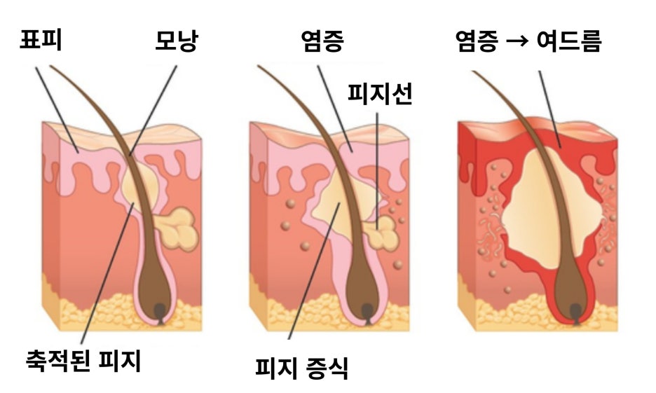 여드름 흉터, 염증 치료 가격만 비교해선 안되는 이유 관련 이미지 5