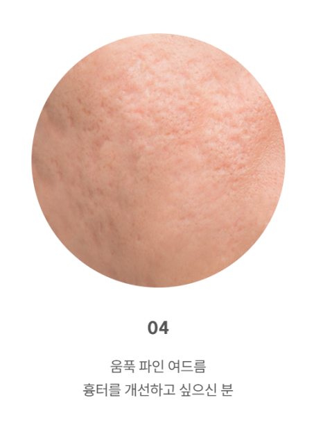 좁쌀 여드름 레이저 시술 전 필독! 이거 알고 받으세요! 관련 이미지 22