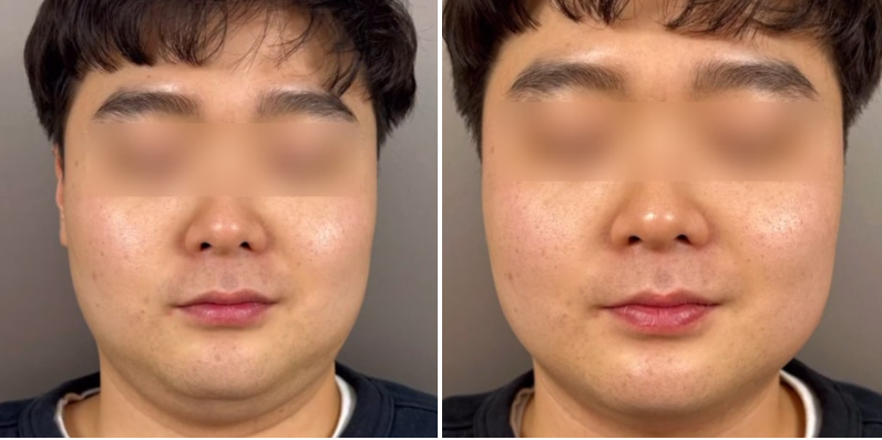 Be Sure to Check These Points for the Full Effects of Cheongdam ONDA Lifting! image 9
