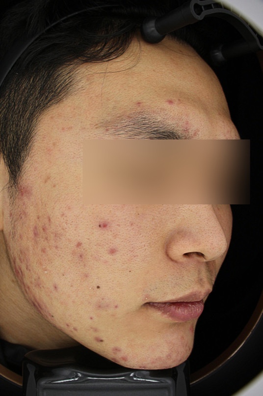 강남여드름피부과? 이렇게 말하는 곳은 거르세요 관련 이미지 2