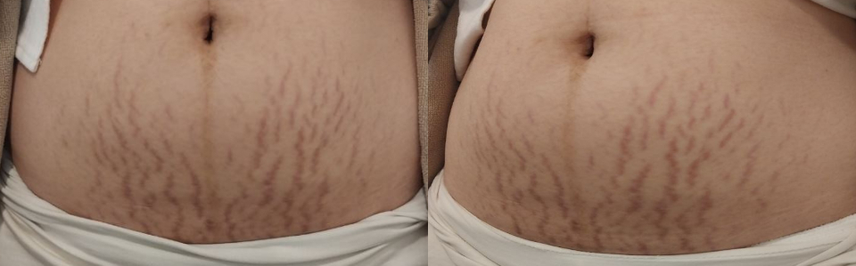 임산부 튼살 크림, 오일로 치료가 힘든 이유 관련 이미지 2