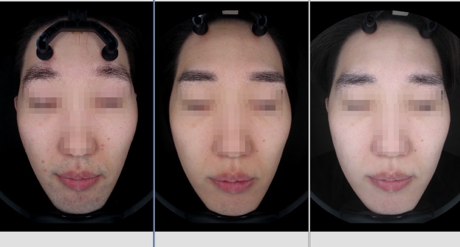 남자 레이저 제모, 면도만 안 해도 피부가 좋아진다? 관련 이미지 6