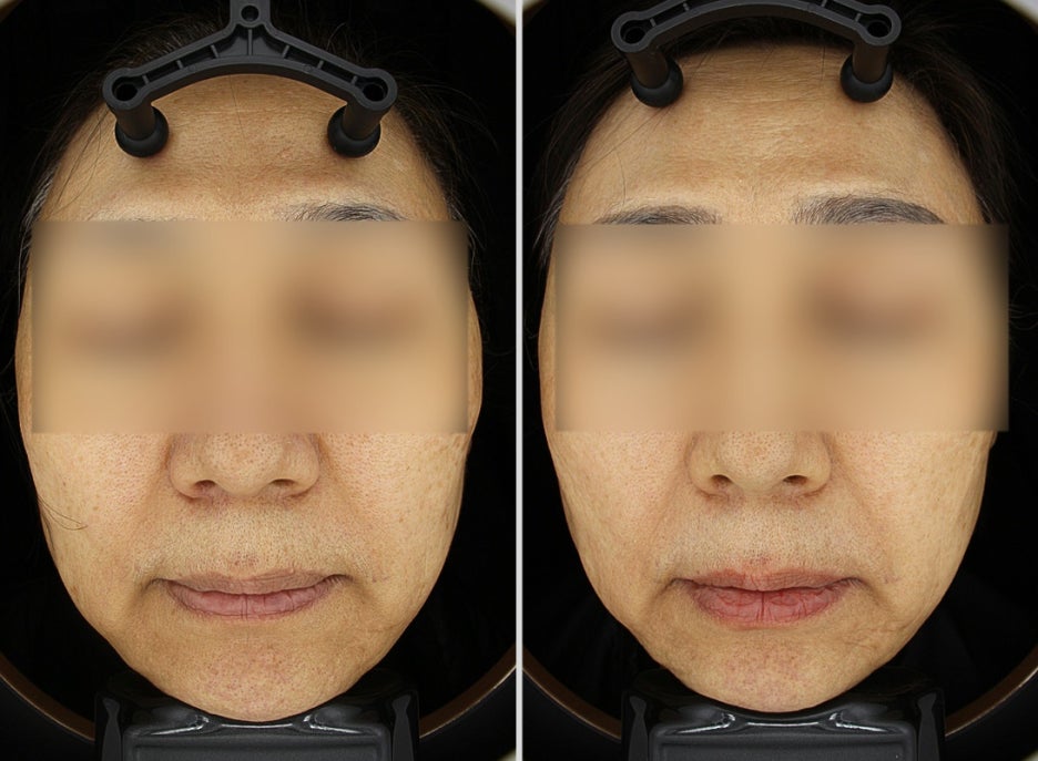 주근깨피부과? 돈만 날리고 효과가 없다면 읽어보세요. 관련 이미지 6