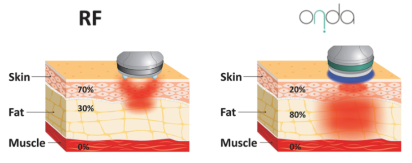 Be Sure to Check These Points for the Full Effects of Cheongdam ONDA Lifting! image 4