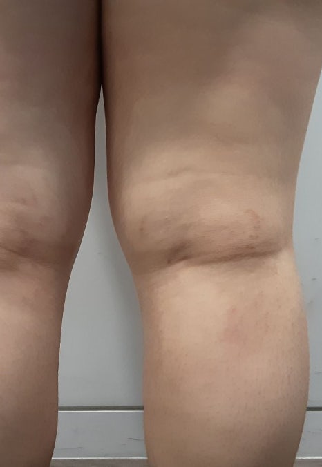 허벅지 튼살 치료, 크림만으로는 효과 볼 수 없어요 관련 이미지 9