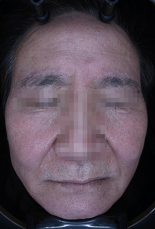 주름 보톡스 효과를 못 보신 분들의 공통점 관련 이미지 7