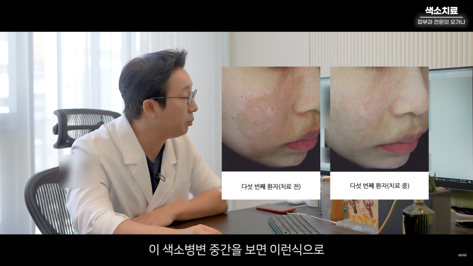 피부과 치료도 과유불급! 색소치료의 모든 것 #기미#색소병변#오타모반 | 오프라이드 오가나 관련 이미지 25