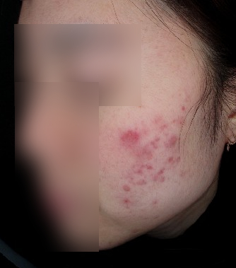 강남여드름흉터피부과? 이런 곳은 피하세요 관련 이미지 1