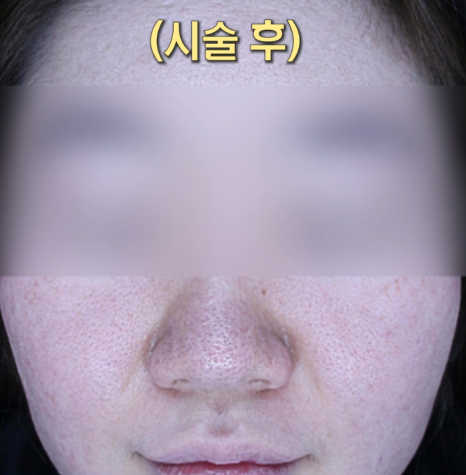 넓은 모공 줄이는 피부과 가성비 시술 소개(feat. 스킨보톡스) 관련 이미지 4