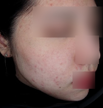 강남여드름흉터피부과? 이런 곳은 피하세요 관련 이미지 12