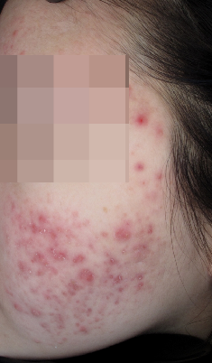 여드름 흉터, 염증 치료 가격만 비교해선 안되는 이유 관련 이미지 2