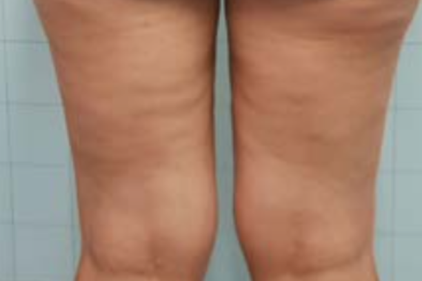 온다 리프팅, 통증에 민감한 분들을 위한 선택지 관련 이미지 9