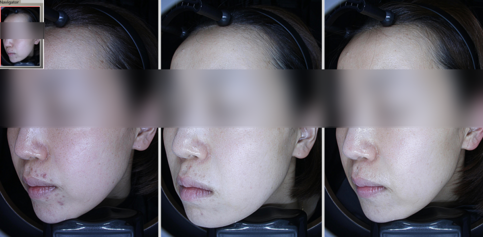 입 주변 여드름 원인, 피부 교정에 답이 있습니다. 관련 이미지 4