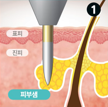 좁쌀 여드름 레이저 시술 전 필독! 이거 알고 받으세요! 관련 이미지 11