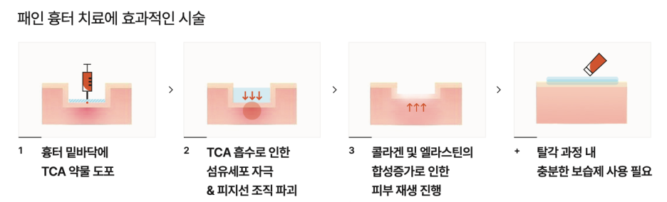허벅지 튼살 치료, 크림만으로는 효과 볼 수 없어요 관련 이미지 7