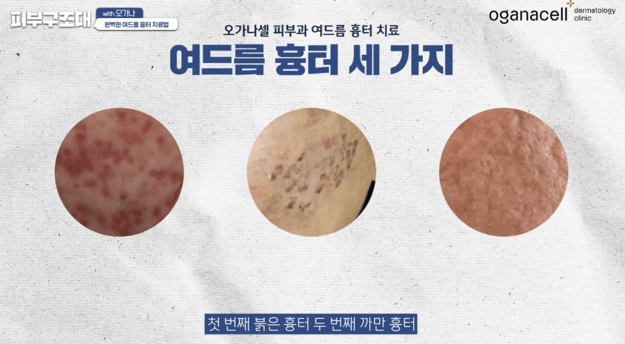 여드름 패인흉터 치료 방법 제대로알자 관련 이미지 8