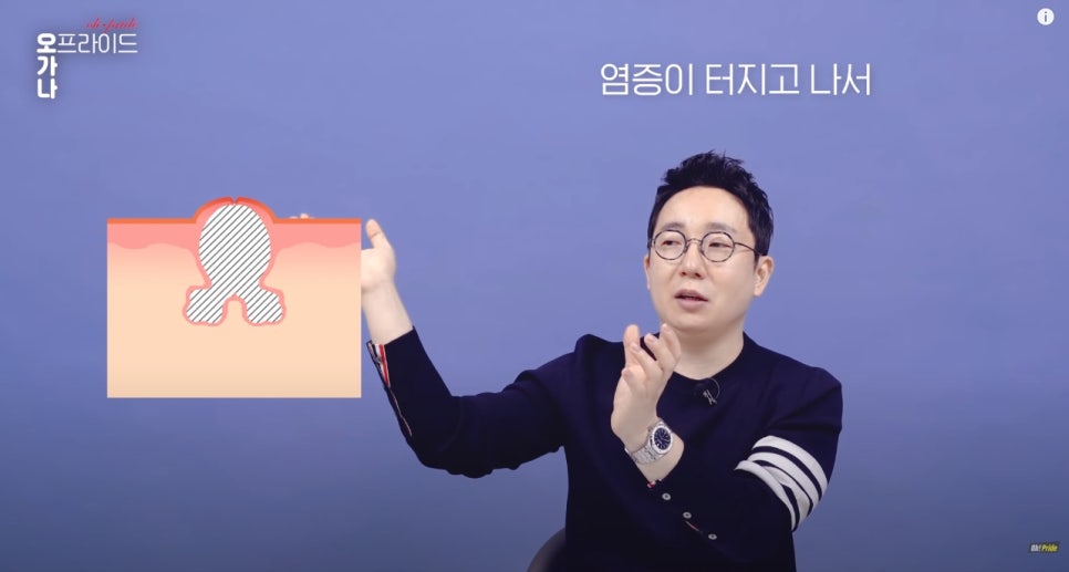 여드름 흉터 치료 가장 확실한 치료법 알려드립니다! | 피부과전문의 오가나 관련 이미지 6