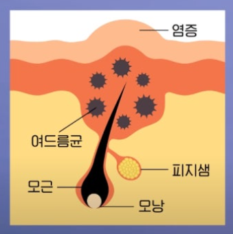 좁쌀 여드름 레이저 시술 전 필독! 이거 알고 받으세요! 관련 이미지 2