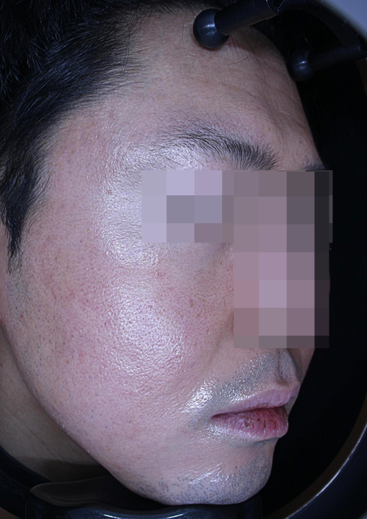 민감성 피부 로션 크림이 효과가 없던 이유 - 피부과 치료 사례 관련 이미지 2
