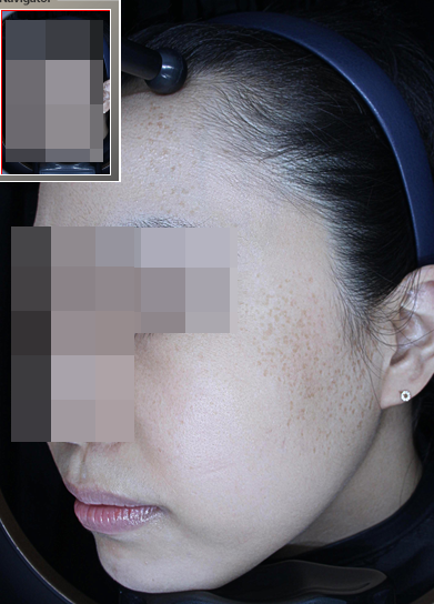 삼성역 인근 피부과 기미, 오타모반? 둘 다 아닐 수 있어요 관련 이미지 4