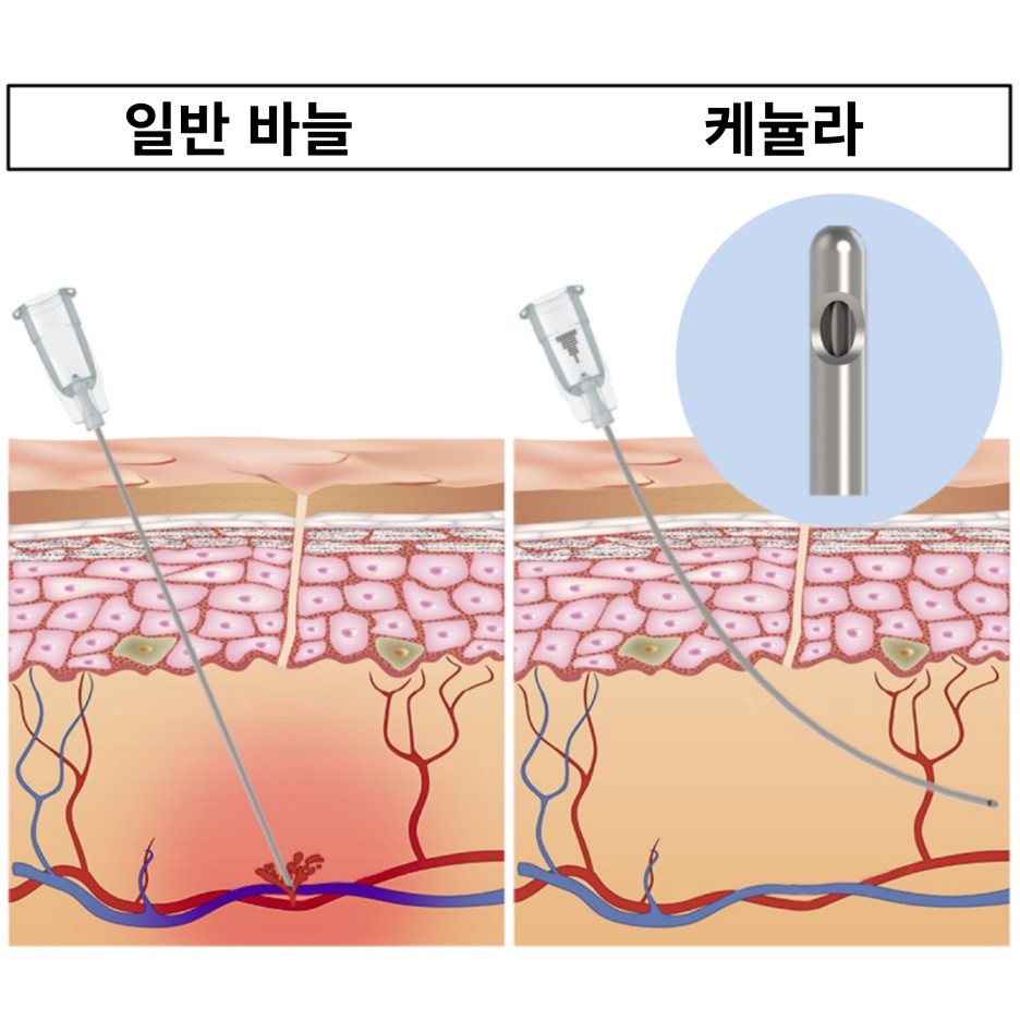 이마 필러 꼭 2가지는 체크해 보시길 당부드립니다. 관련 이미지 11