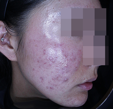 20대 여성 여드름 흉터 레이저 종류와 치료 사례 관련 이미지 11