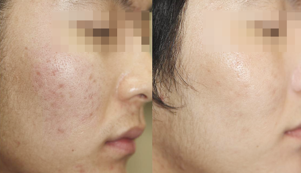 30/40대여드름? 치료의 핵심 2가지 알려드립니다 - 의사 작성 관련 이미지 2