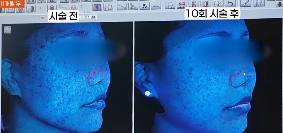 Real Acne Skin Correction Review (Feat. Before/After Photos of Acne in Your 30s) image 8