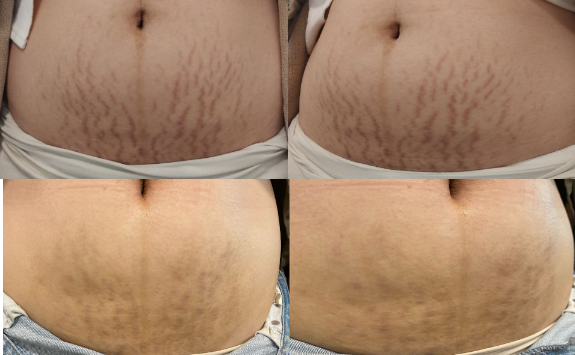 임산부 튼살 크림, 오일로 치료가 힘든 이유 관련 이미지 9