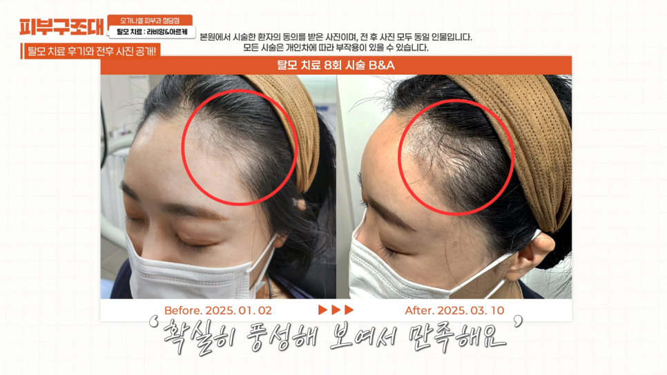 탈모치료, 이제 탈모샴푸 안써도됩니다 (라비앙,아르케,더마펜) 관련 이미지 6