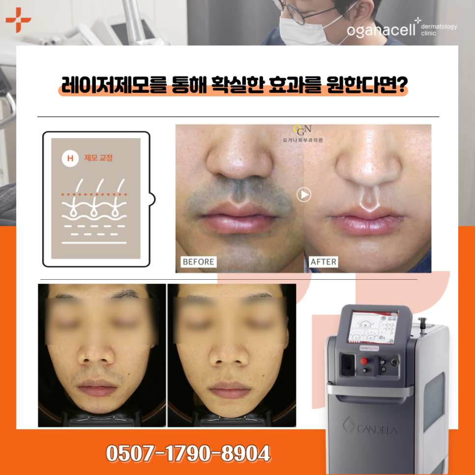 강남레이저제모 젠틀맥스프로 통증 얼마나? 관련 이미지 8