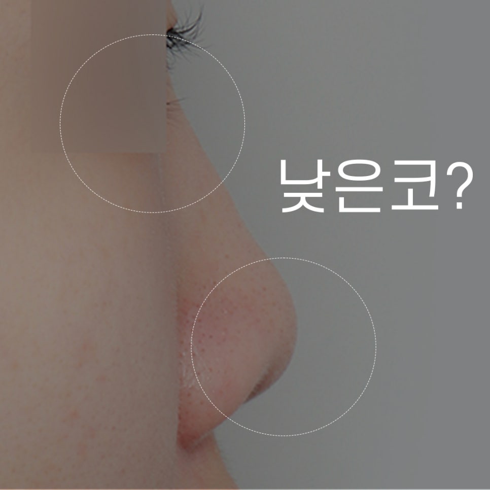 Let’s Find Confidence with a Small, Low Nose and a Beautiful Nose Shape! image 1