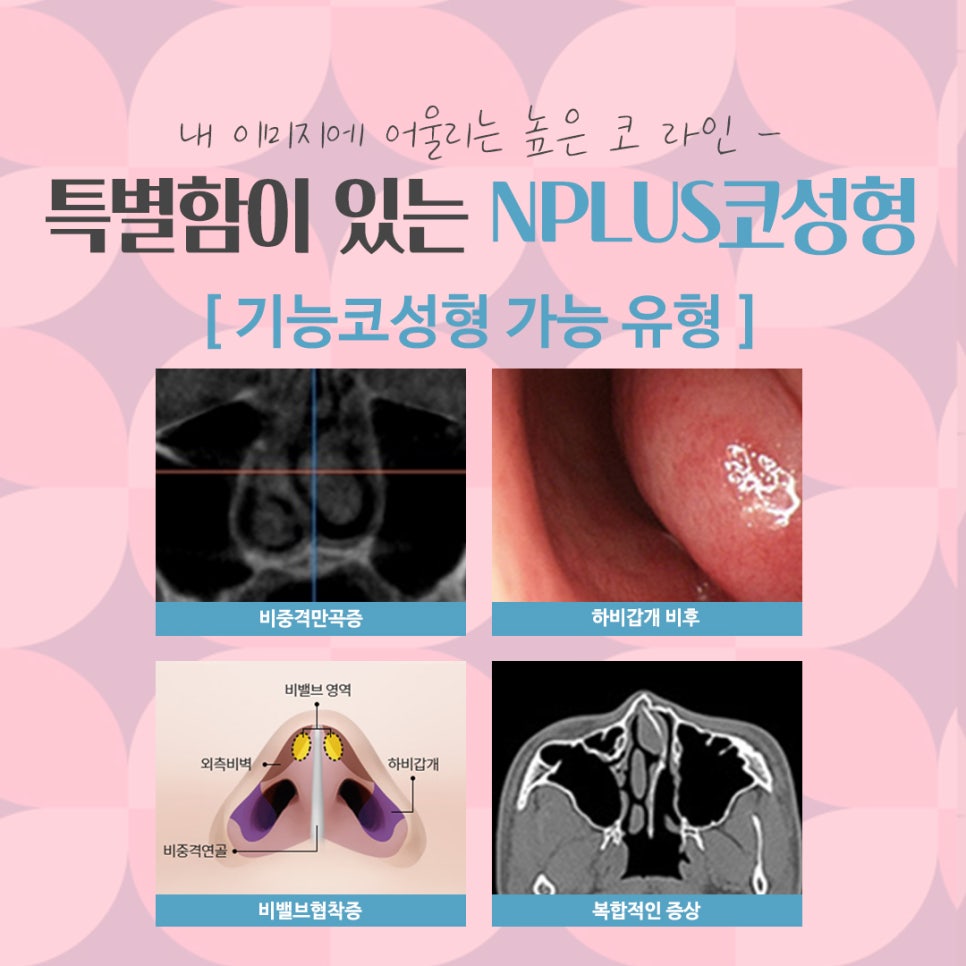 Nose Surgery Review with a Natural Nose Line image 5