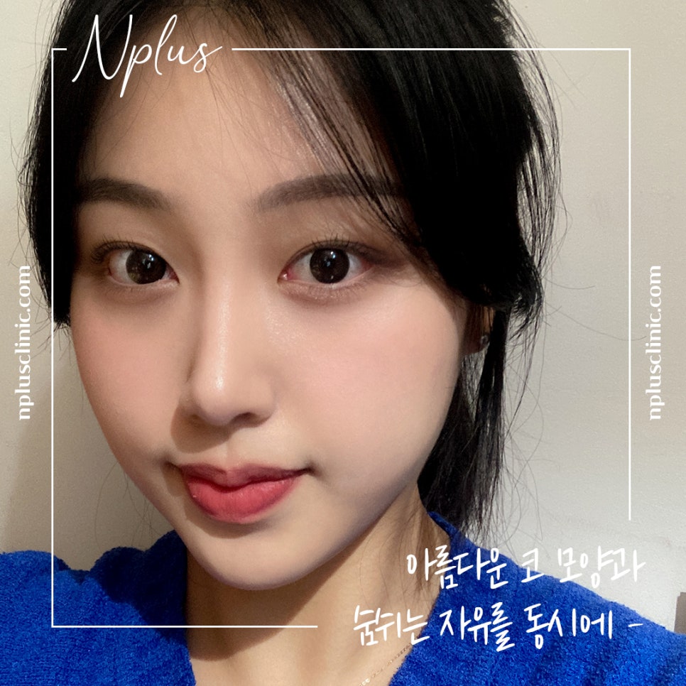 콧볼축소수술 확실한 교정으로 관련 이미지 1