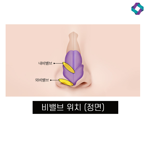 비염수술코성형 비밸브 교정술! 관련 이미지 5