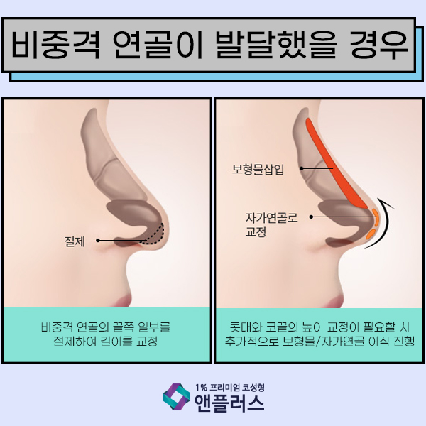 화살코성형 코끝이 고민일때 관련 이미지 4