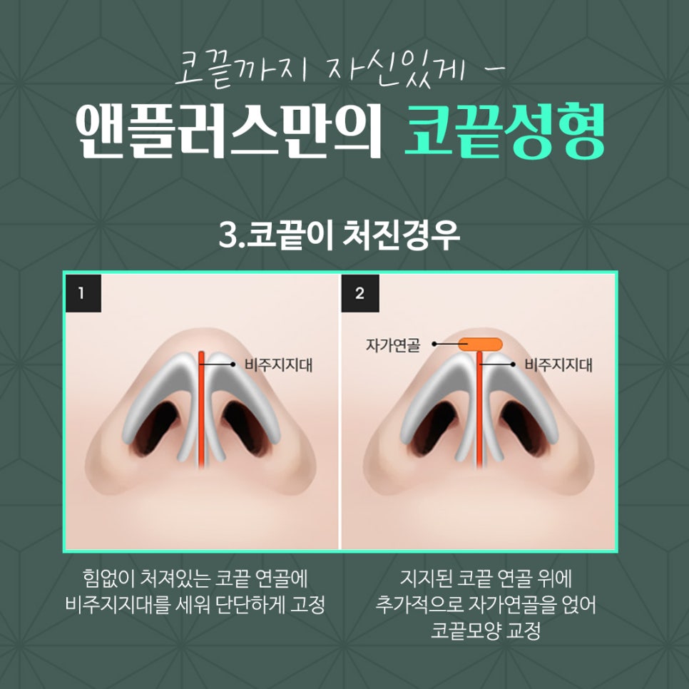 코끝연골묶기 활용한 코끝성형 관련 이미지 8
