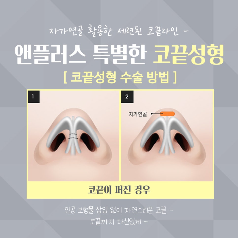 Tip Plasty Through Tip Cartilage Stitching image 10