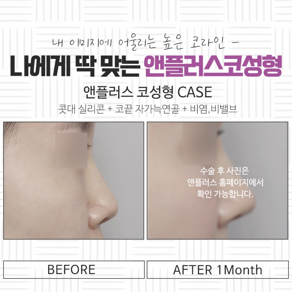 자가연골코성형을 통해 자연스럽고 예쁜 라인으로 관련 이미지 14