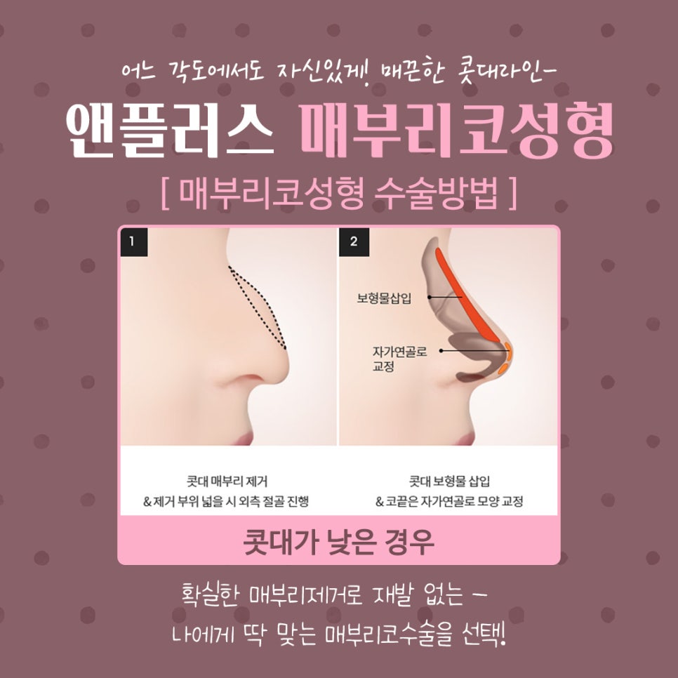 코끝처짐 개선한 매부리코성형후기 관련 이미지 9