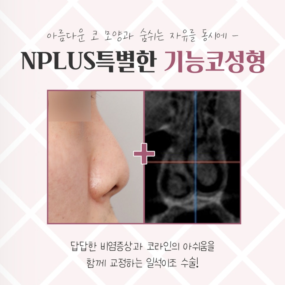 한쪽코막힘을 해결하는 방법 관련 이미지 4