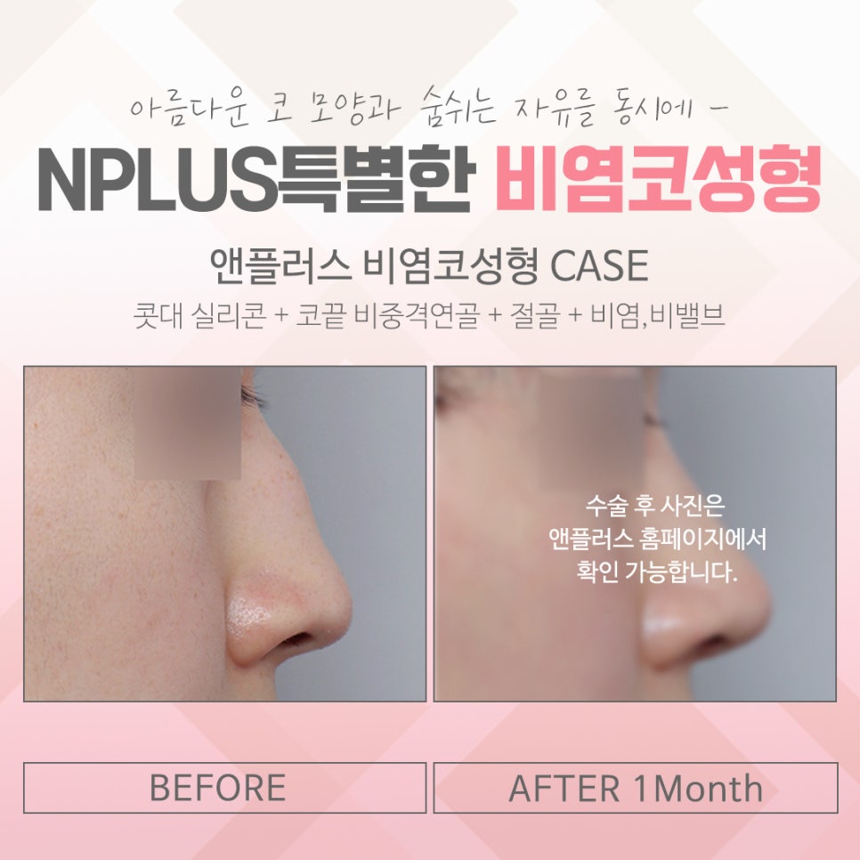 비염수술후기에 대한 정보를 알아보고 관련 이미지 13
