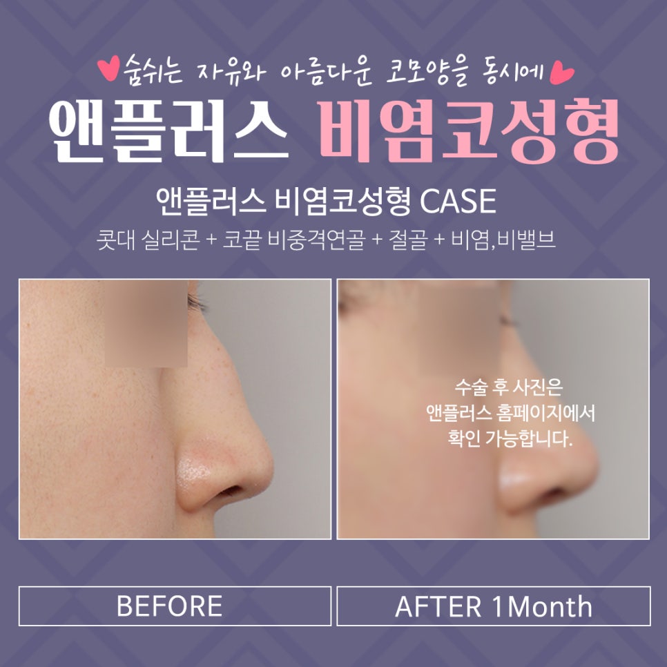 강남앤플러스 비염수술후기 관련 이미지 10