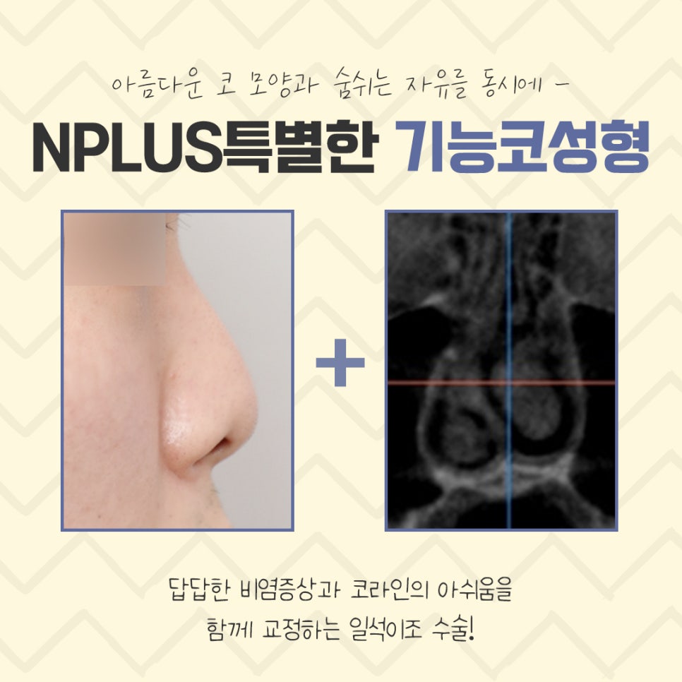 Functional Rhinoplasty Review at a Top Gangnam Nose Surgery Clinic image 4