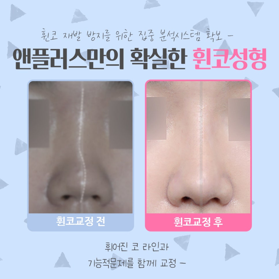 휜코성형 정확한 문제 파악으로 관련 이미지 4