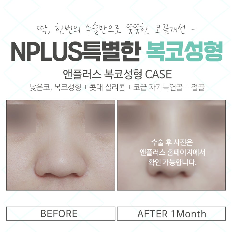 When Looking at Bulbous Nose Surgery Reviews image 15