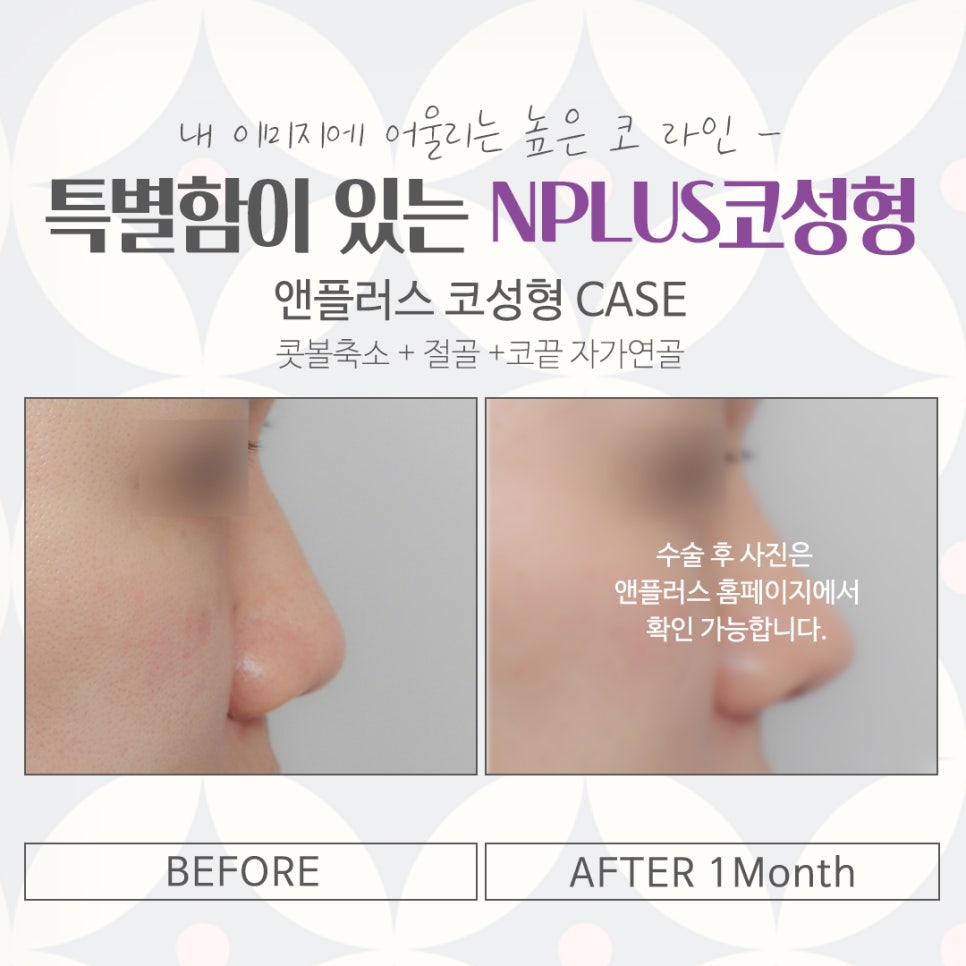 압구정성형외과에서 알려드리는 코수술후기 관련 이미지 15