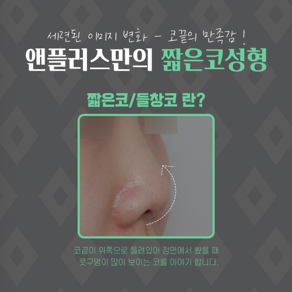 Elevating the Columellar Support to Complete Short Nose Surgery image 4