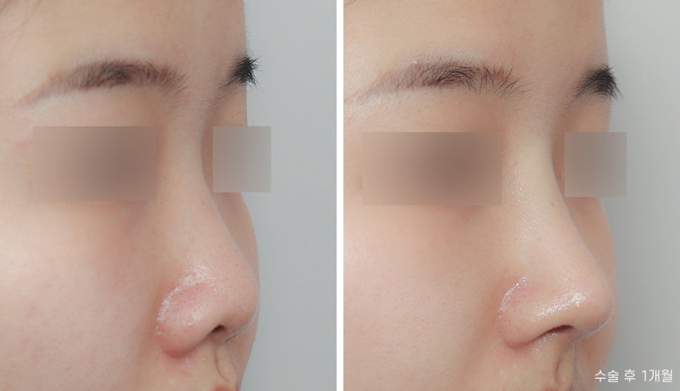 Let’s Find Confidence with a Small, Low Nose and a Beautiful Nose Shape! image 3